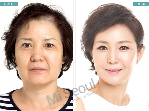 lv plastic surgery seoul|korean face lift surgery.